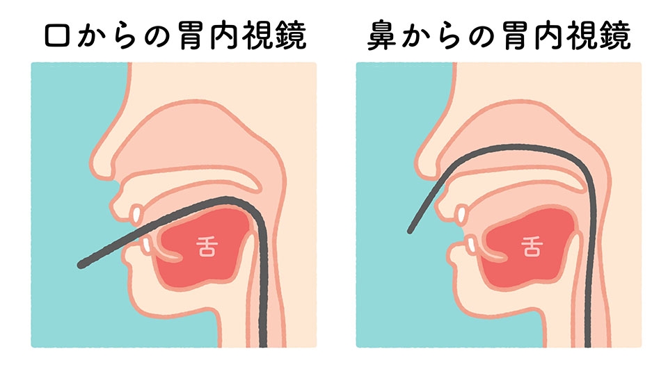 経口内視鏡と経鼻内視鏡の両方に対応